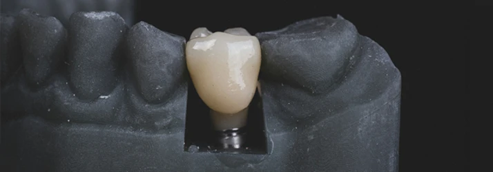 FC – Advanced Dental Implant Solutions for Long-Term Oral Function at Brilla Dental Group in Santa Maria CA