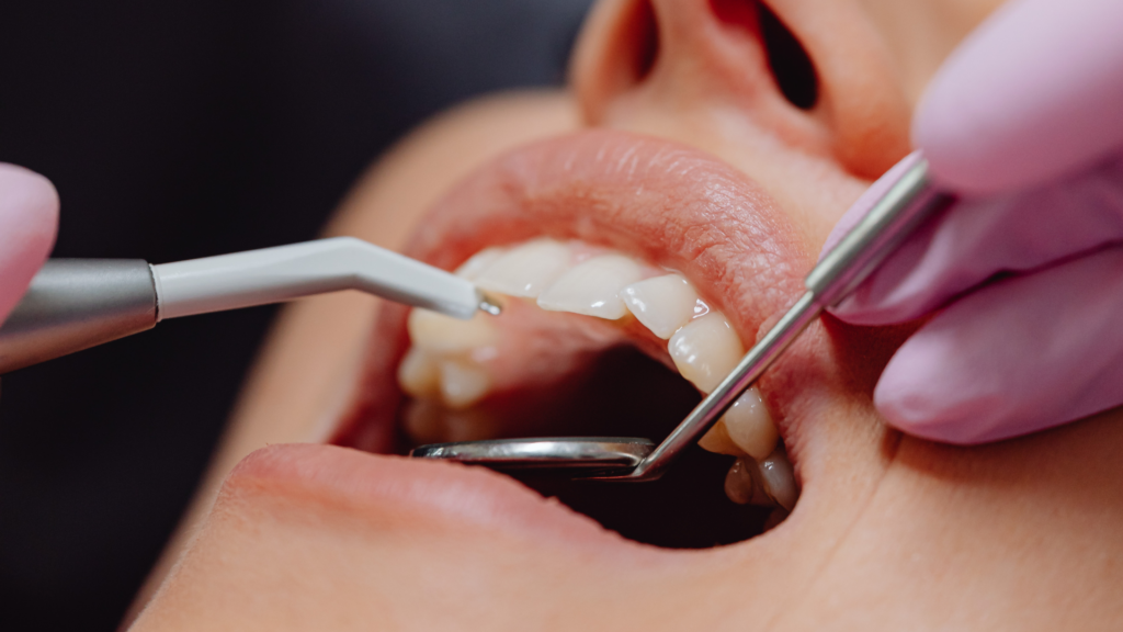 Close-up of dentist using mouth mirror during urgent examination for Emergency Dental Services page in CA.